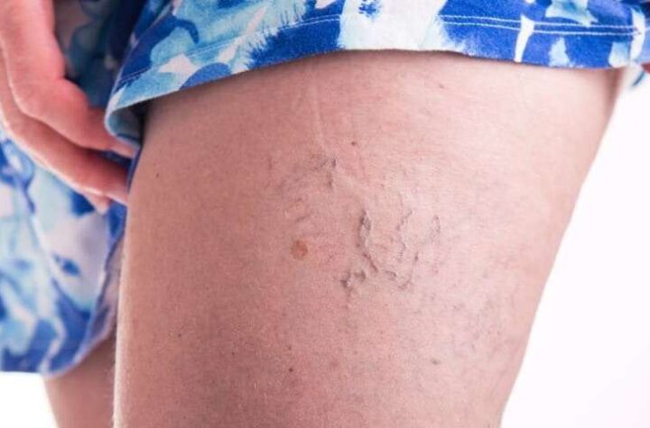 Treatment For Varicose Veins