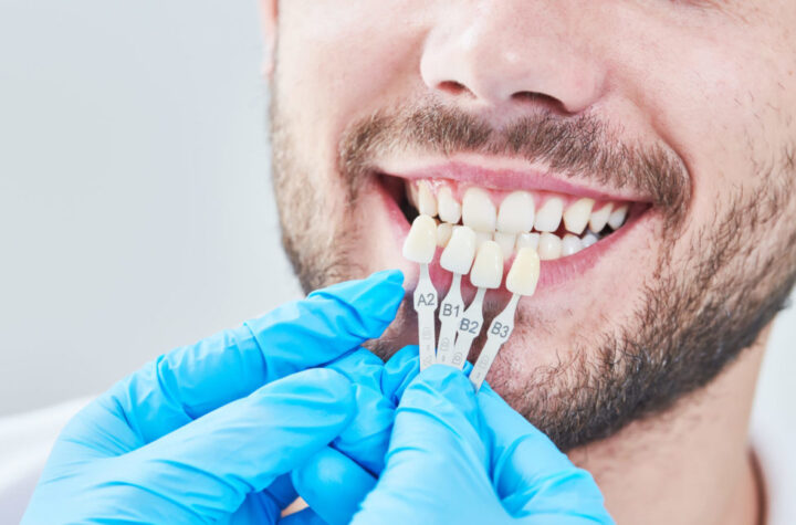 Dental Veneers: What Are Its Benefits?